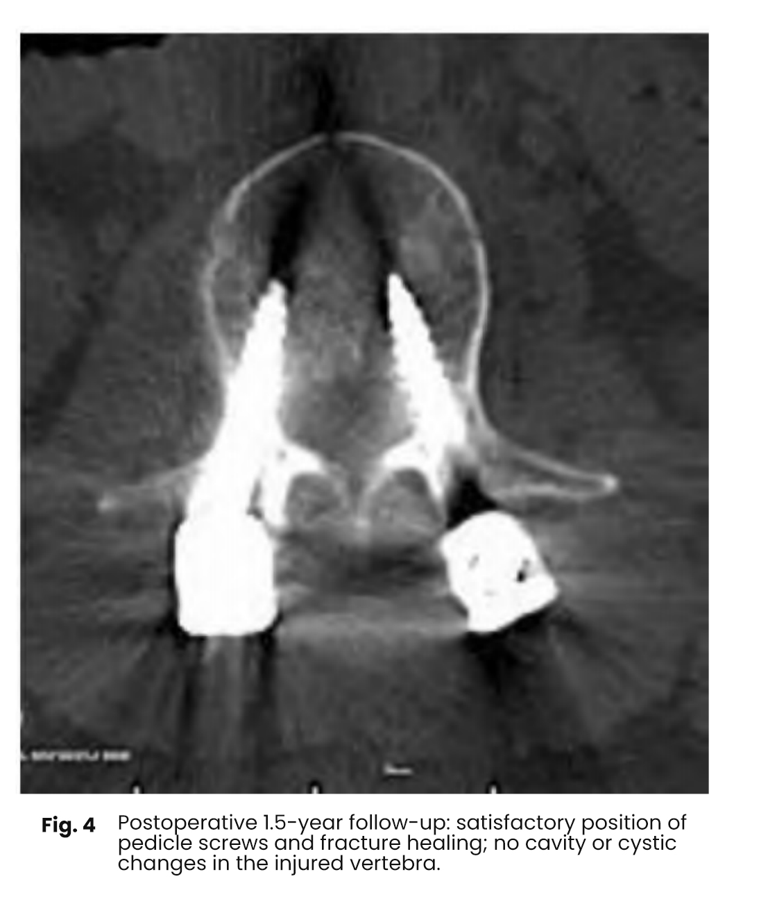 In all cases involving bone grafting the pedicle screw rod fixation and reduction of the injured vertebrae were satisfactory