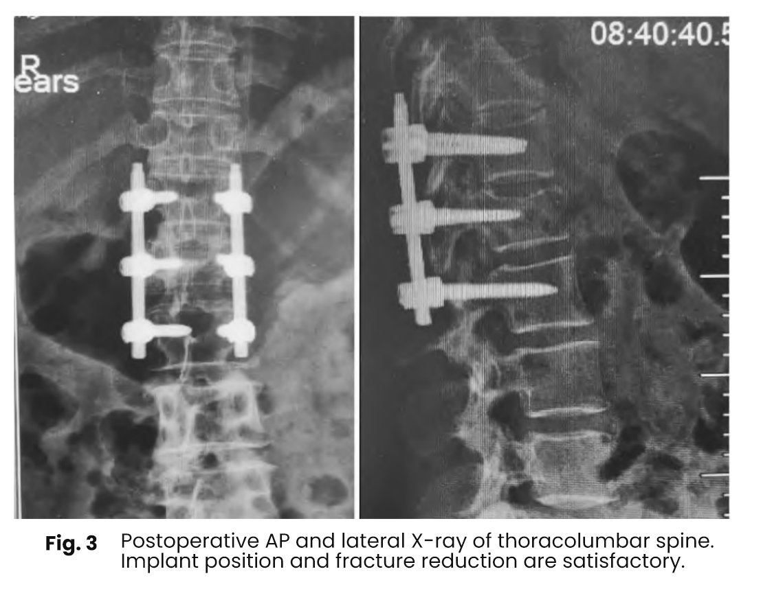 furthermore fracture healing was observed without any signs of vertebral clefts or cystic cavitation within the vertebral bodies